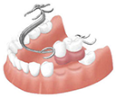 部分入れ歯