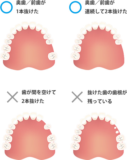 コンフォート ソケット