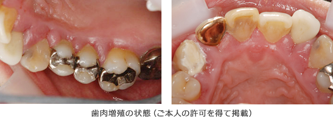 歯茎 の 腫れ に 効く 薬