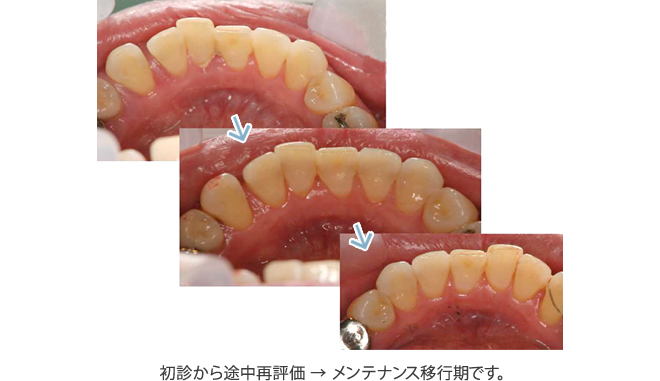 初診から途中再評価 → メンテナンス移行期です。