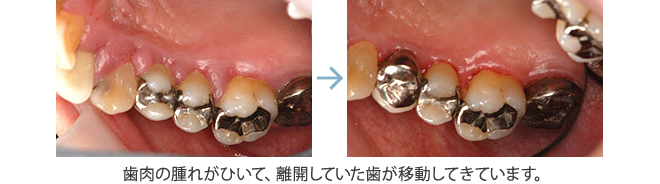 歯肉の腫れがひいて、離開していた歯が移動してきています。