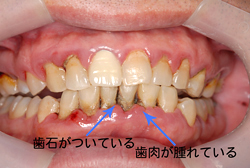 歯石がついている・歯肉が腫れているなどの症状が見られる歯の様子