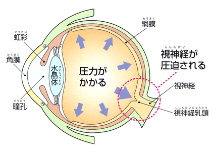 緑内障