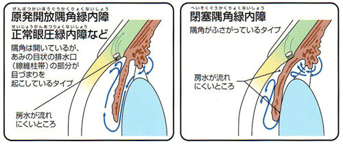 緑内障の種類の図