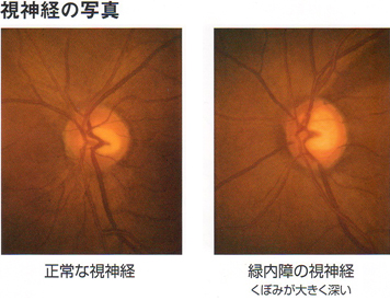 正常な視神経と緑内障の視神経の比較写真