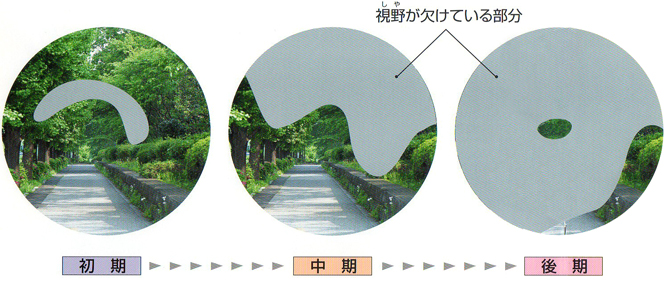 緑内障の症状の進み方