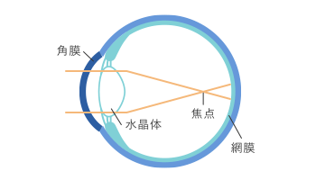 装用前(近視の状態)