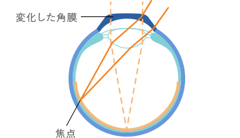 オルソケラトロジー後