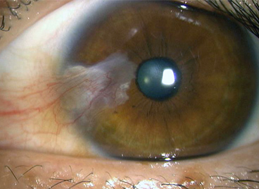 白目（結膜）の一部が黒目（角膜）に侵入