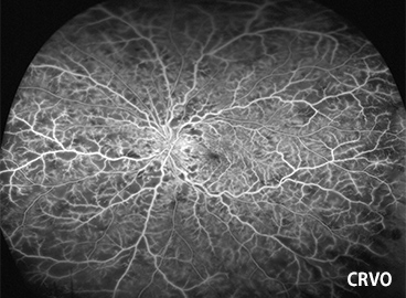 蛍光眼底造影検査（網膜虚血を伴う網膜中心静脈閉塞症）