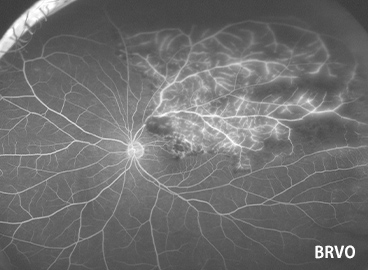 蛍光眼底造影検査（網膜虚血を伴う網膜静脈分枝閉塞症）