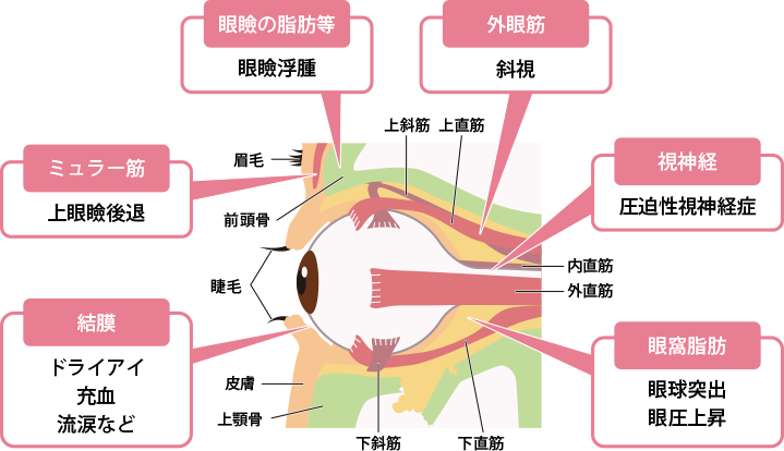 橋本甲状腺炎の症状は何ですか?