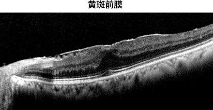 黄斑前膜