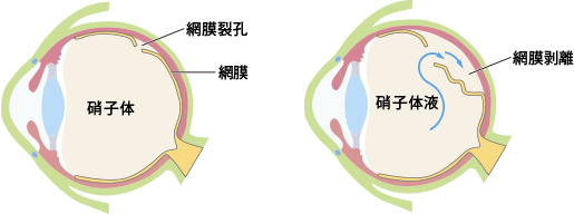 網膜剥離