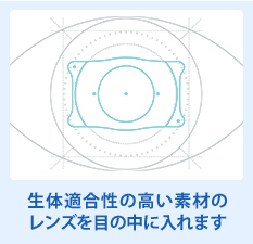 生体適合性の高い素材のレンズを目の中に入れます