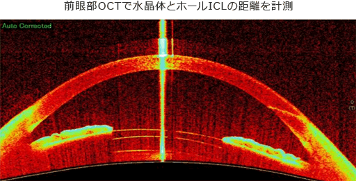 前眼部OCTで水晶体とホールICLの距離を計測