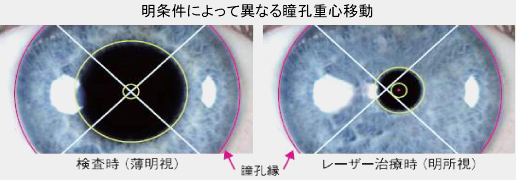 明条件によって異なる瞳孔重心移動　検査時（透明視）　レーザー治療時（明所視）　瞳孔縁