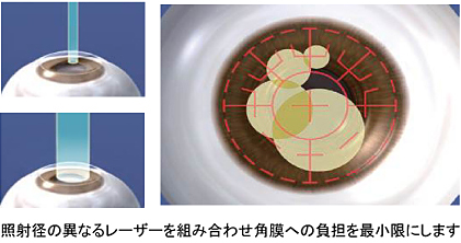 照射径の異なるレーザーを組み合わせ角膜への負担を最小限にします
