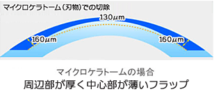 マイクロケラトーム（刃物）での切除　マイクロケラトームの場合　周辺部が厚く中心部が薄いフラップ