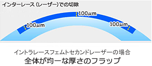 インターレース（レーザー）での切除　イントラレースフェムトセカンドレーザーの場合　全体が均一な厚さのフラップ