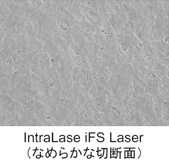 IntraLase iFS Laser(なめらかな切断面)