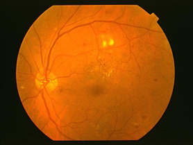 增殖前期视网膜病变