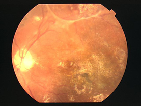 増殖性视网膜病变
