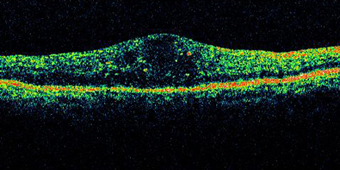 糖尿病黄斑水肿的视网膜截面图