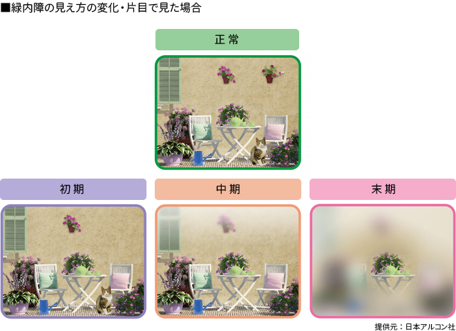 緑内障の見え方の変化・片目で見た場合　提供元：日本アルコン社