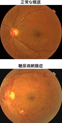 正常な眼底と糖尿病網膜症の眼底