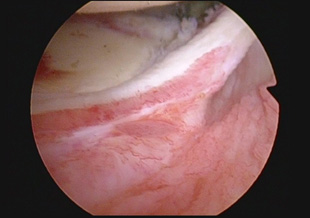 肩関節鏡視像