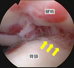 肩関節鏡写真