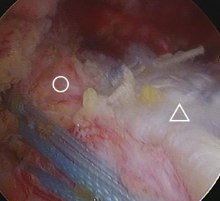 肩関節鏡写真